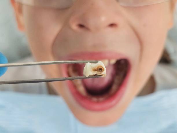 Best Emergency Treatment for Dental Infections or Abscesses in Ligonier, IN