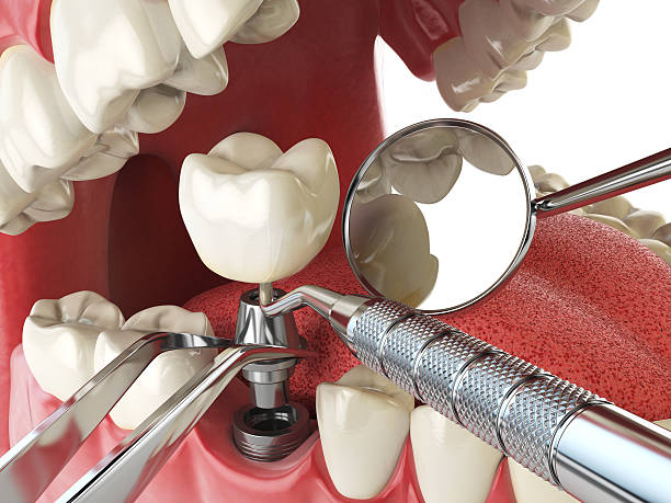Best Urgent Care for Lost Fillings or Crowns in Ligonier, IN