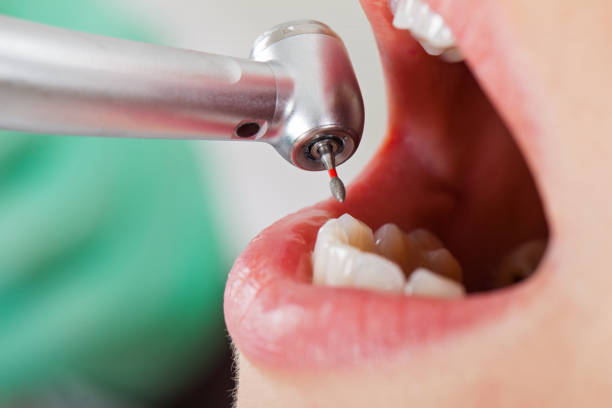 Best Emergency Dental Care for Broken or Chipped Teeth in Ligonier, IN